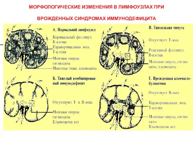 МОРФОЛОГИЧЕСКИЕ ИЗМЕНЕНИЯ В ЛИМФОУЗЛАХ ПРИ ВРОЖДЕННЫХ СИНДРОМАХ ИММУНОДЕФИЦИТА