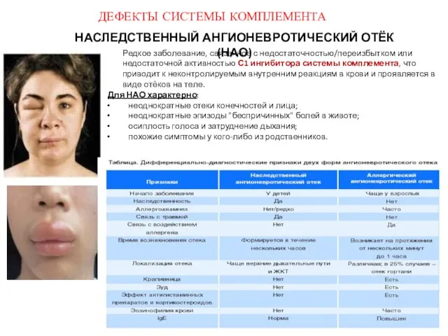 ДЕФЕКТЫ СИСТЕМЫ КОМПЛЕМЕНТА НАСЛЕДСТВЕННЫЙ АНГИОНЕВРОТИЧЕСКИЙ ОТЁК (НАО) Редкое заболевание, связанное