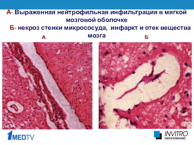 А- Выраженная нейтрофильная инфильтрация в мягкой мозговой оболочке Б- некроз