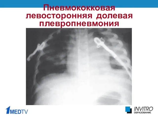 Пневмококковая левосторонняя долевая плевропневмония