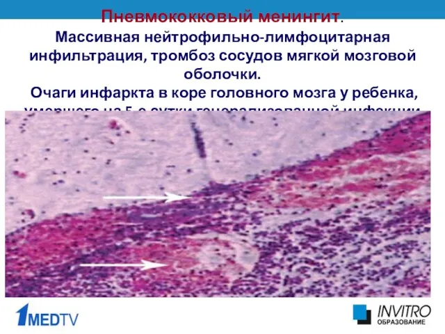 Пневмококковый менингит. Массивная нейтрофильно-лимфоцитарная инфильтрация, тромбоз сосудов мягкой мозговой оболочки.