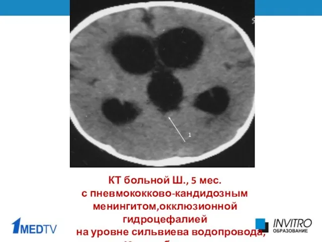 КТ больной Ш., 5 мес. с пневмококково-кандидозным менингитом,окклюзионной гидроцефалией на уровне сильвиева водопровода, 49 день болезни