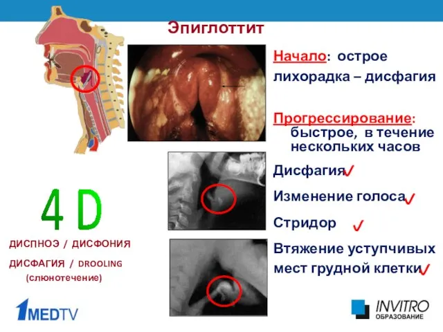 Эпиглоттит Начало: острое лихорадка – дисфагия Прогрессирование: быстрое, в течение