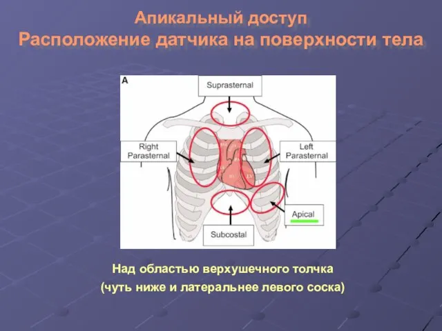 Апикальный доступ Расположение датчика на поверхности тела Над областью верхушечного