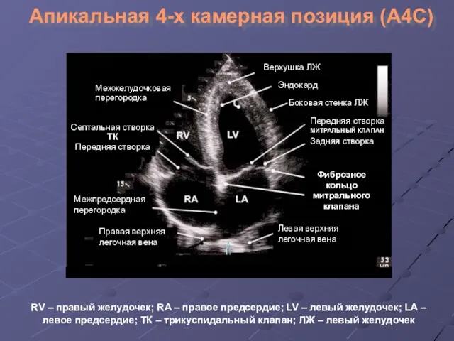 Апикальная 4-х камерная позиция (А4С) Верхушка ЛЖ Эндокард Боковая стенка