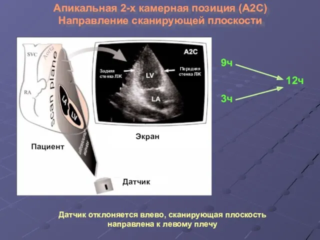 Апикальная 2-х камерная позиция (А2С) Направление сканирующей плоскости Пациент Датчик