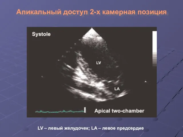 Апикальный доступ 2-х камерная позиция LV – левый желудочек; LA – левое предсердие