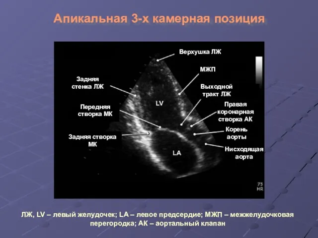 Апикальная 3-х камерная позиция Задняя стенка ЛЖ Передняя створка МК