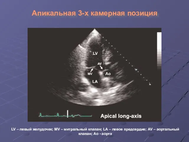 Апикальная 3-х камерная позиция LV – левый желудочек; MV –