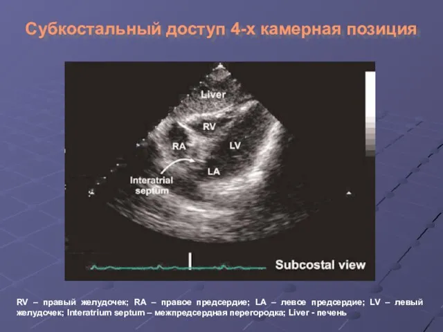 Субкостальный доступ 4-х камерная позиция RV – правый желудочек; RA