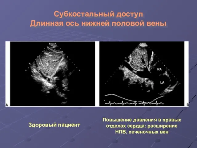 Субкостальный доступ Длинная ось нижней половой вены Здоровый пациент Повышение