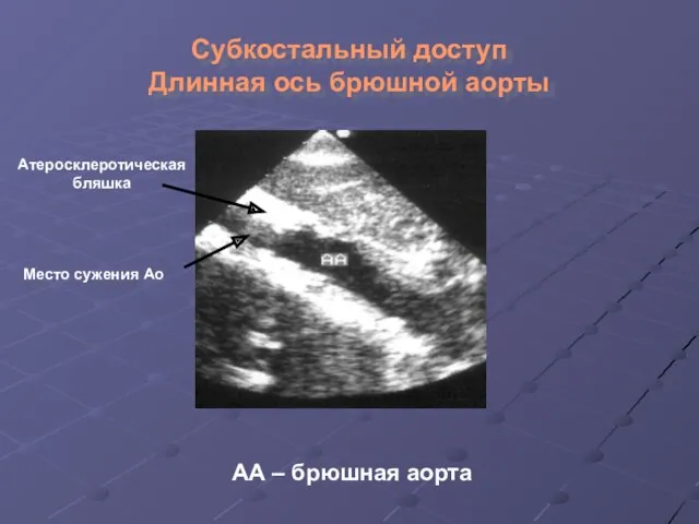 Субкостальный доступ Длинная ось брюшной аорты АА – брюшная аорта Атеросклеротическая бляшка Место сужения Ао