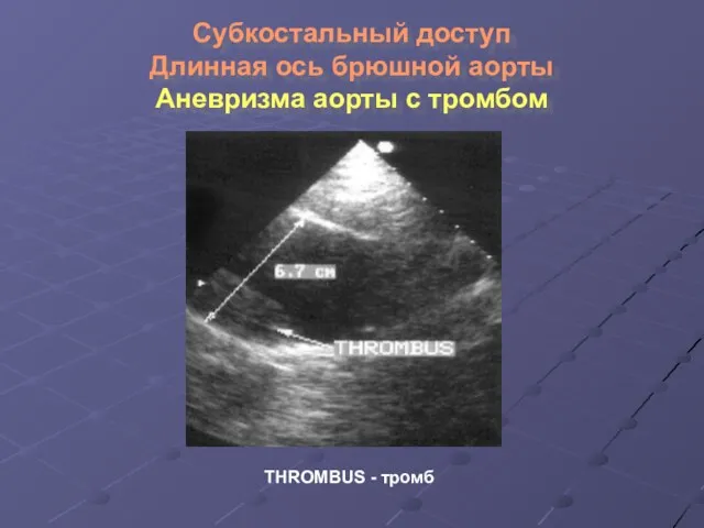 Субкостальный доступ Длинная ось брюшной аорты Аневризма аорты с тромбом THROMBUS - тромб