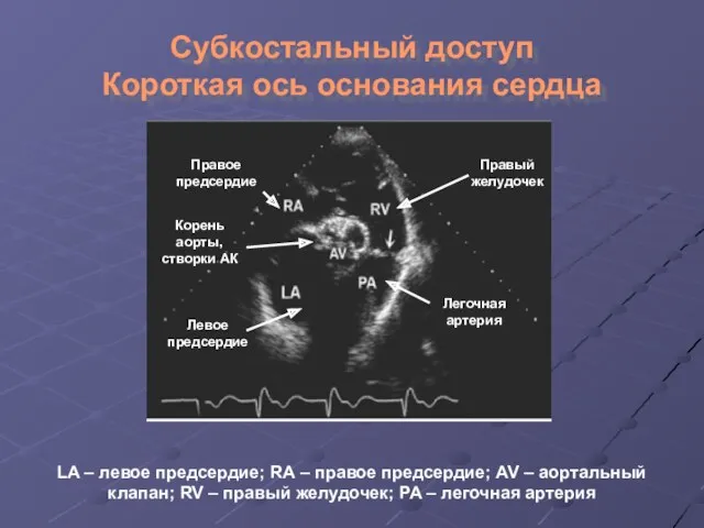 Субкостальный доступ Короткая ось основания сердца LA – левое предсердие;