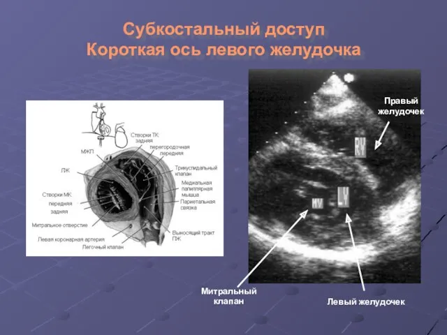 Субкостальный доступ Короткая ось левого желудочка Правый желудочек Митральный клапан Левый желудочек