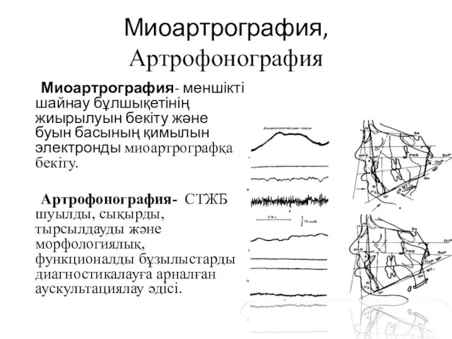 Миоартрография, Артрофонография Миоартрография- меншікті шайнау бұлшықетінің жиырылуын бекіту және буын
