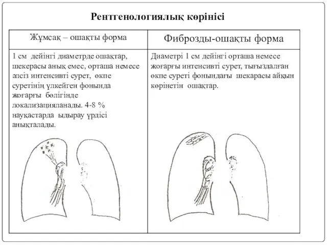 Рентгенологиялық көрінісі