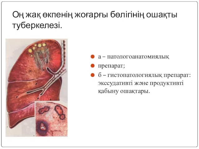 Оң жақ өкпенің жоғарғы бөлігінің ошақты туберкелезі. а – патологоанатомиялық