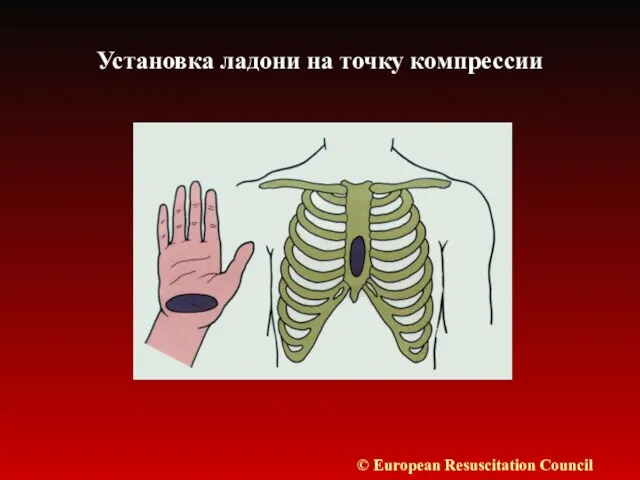 Установка ладони на точку компрессии © European Resuscitation Council