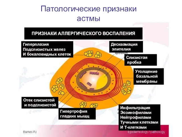 Патологические признаки астмы Гипертрофия гладких мыщц Десквамация эпителия Инфильтрация Эозинофилами