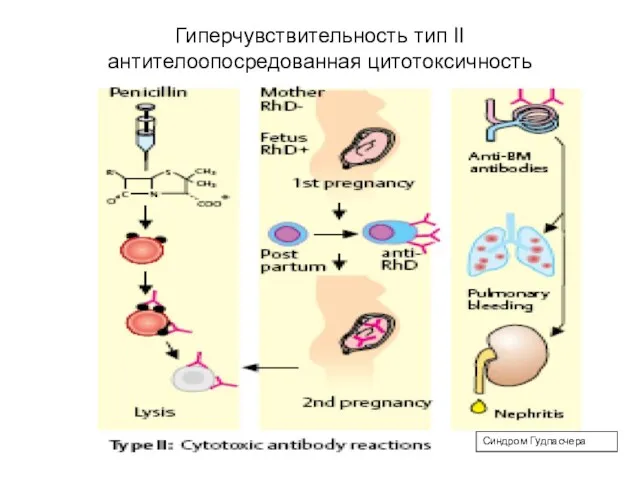 Гиперчувствительность тип II антителоопосредованная цитотоксичность Синдром Гудпасчера