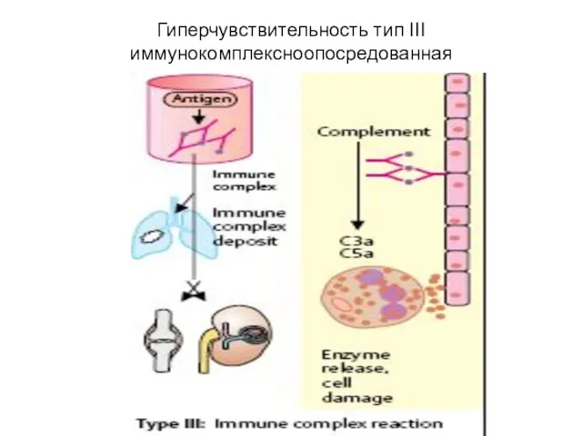 Гиперчувствительность тип III иммунокомплексноопосредованная