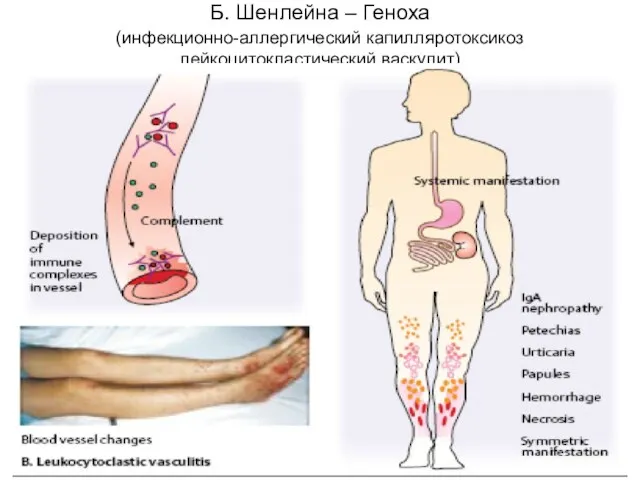 Б. Шенлейна – Геноха (инфекционно-аллергический капилляротоксикоз лейкоцитокластический васкулит)