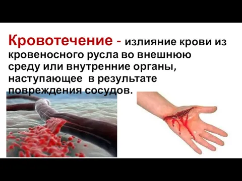 Кровотечение - излияние крови из кровеносного русла во внешнюю среду или внутренние органы,