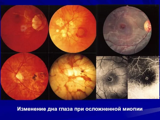 Изменение дна глаза при осложненной миопии