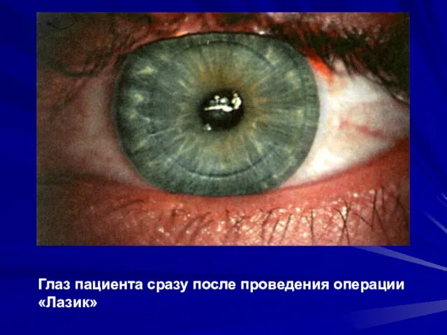 Глаз пациента сразу после проведения операции «Лазик»