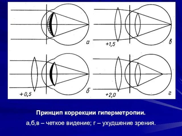 Принцип коррекции гиперметропии. а,б,в – четкое видение; г – ухудшение зрения.