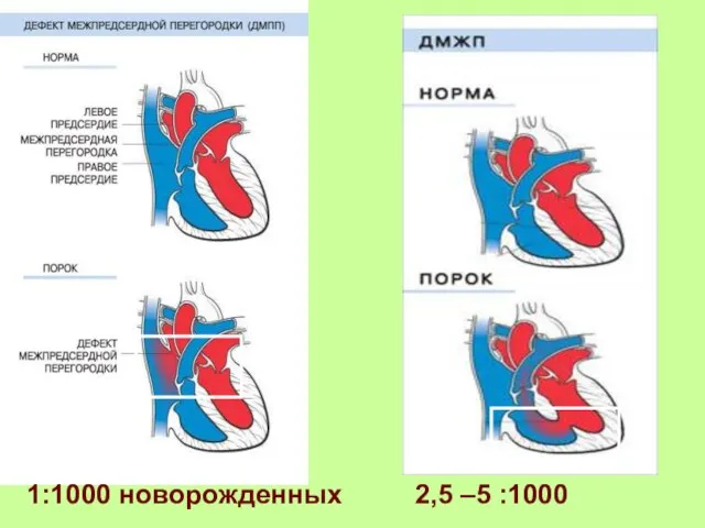 1:1000 новорожденных 2,5 –5 :1000