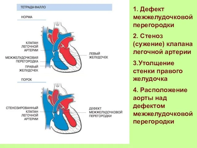 1. Дефект межжелудочковой перегородки 2. Стеноз (сужение) клапана легочной артерии