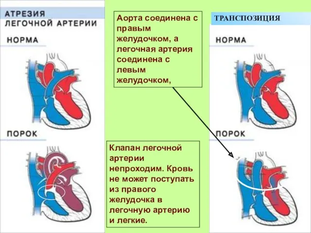 Клапан легочной артерии непроходим. Кровь не может поступать из правого