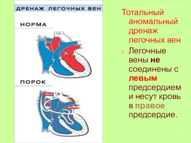 Тотальный аномальный дренаж легочных вен Легочные вены не соединены с