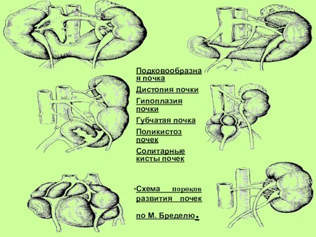 Подковообразная почка Дистопия почки Гипоплазия почки Губчатая почка Поликистоз почек