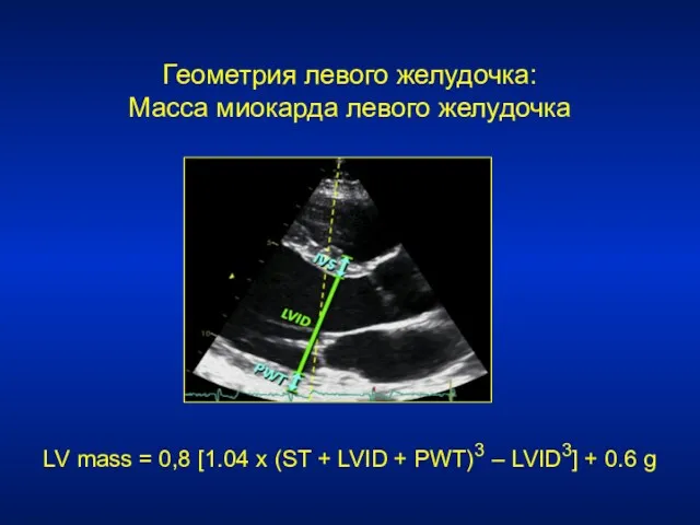 Геометрия левого желудочка: Масса миокарда левого желудочка LV mass = 0,8 [1.04 x