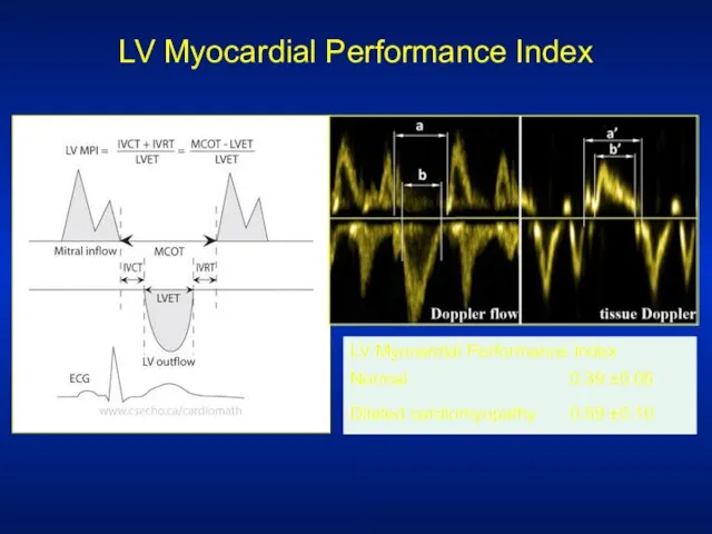 LV Myocardial Performance Index