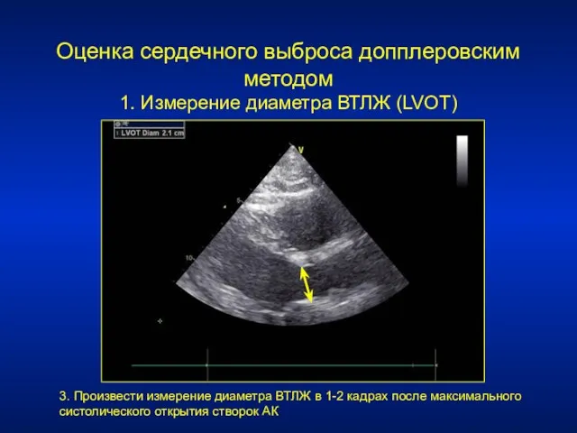 Оценка сердечного выброса допплеровским методом 1. Измерение диаметра ВТЛЖ (LVOT) 3. Произвести измерение
