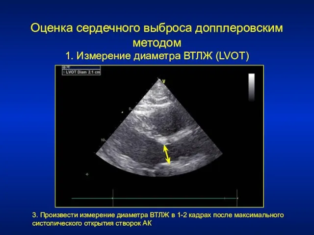 Оценка сердечного выброса допплеровским методом 1. Измерение диаметра ВТЛЖ (LVOT)