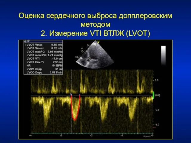 Оценка сердечного выброса допплеровским методом 2. Измерение VTI ВТЛЖ (LVOT)