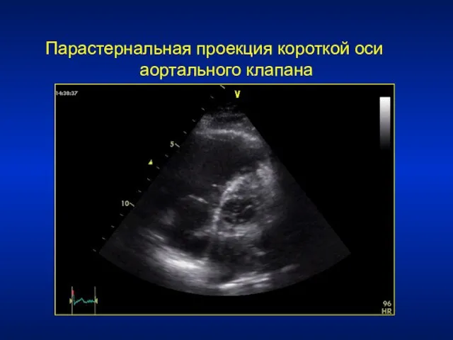 Парастернальная проекция короткой оси аортального клапана