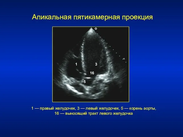 Апикальная пятикамерная проекция 1 — правый желудочек, 3 — левый