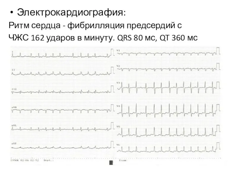 Электрокардиография: Ритм сердца - фибрилляция предсердий с ЧЖС 162 ударов