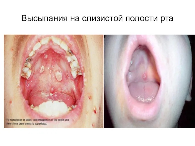 Высыпания на слизистой полости рта