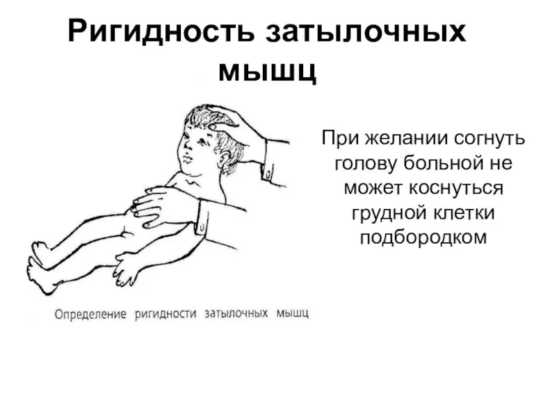 При желании согнуть голову больной не может коснуться грудной клетки подбородком Ригидность затылочных мышц