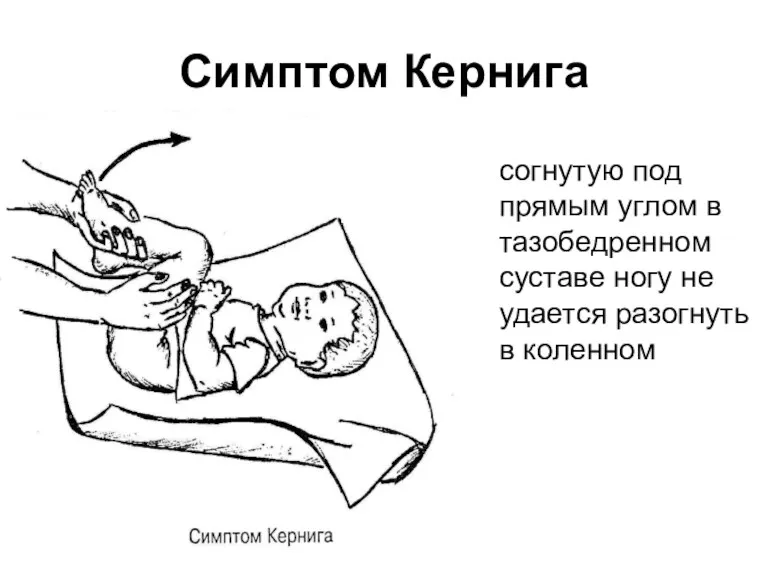 согнутую под прямым углом в тазобедренном суставе ногу не удается разогнуть в коленном Симптом Кернига