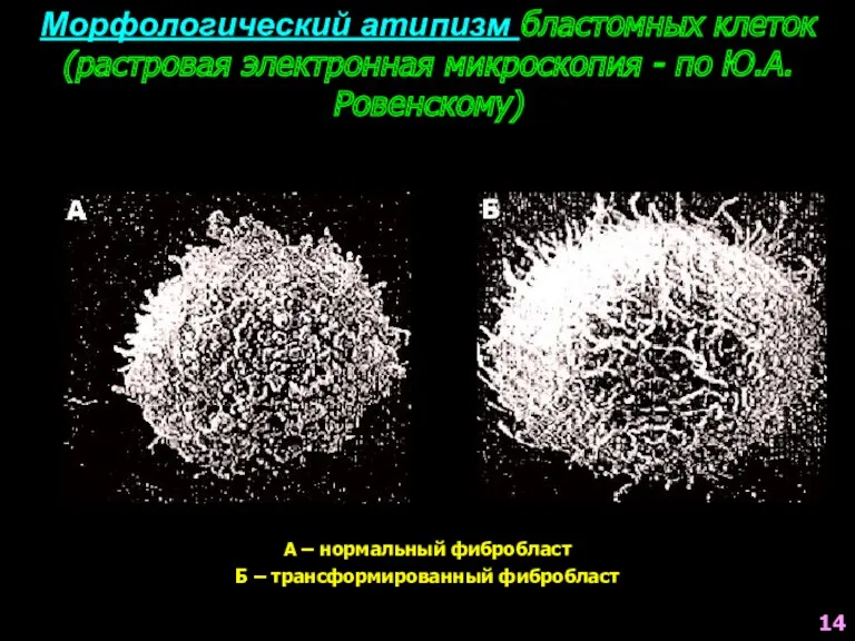 Морфологический атипизм бластомных клеток (растровая электронная микроскопия - по Ю.А.Ровенскому)