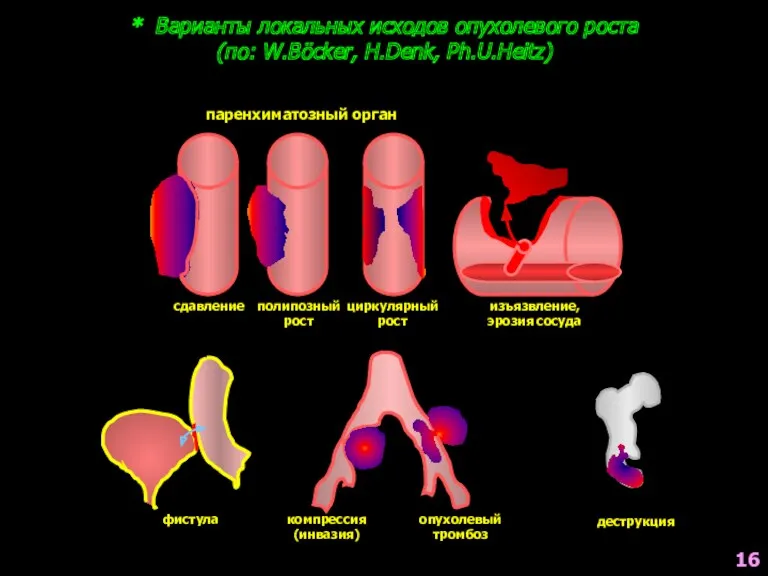 * Варианты локальных исходов опухолевого роста (по: W.Böcker, H.Denk, Ph.U.Heitz)