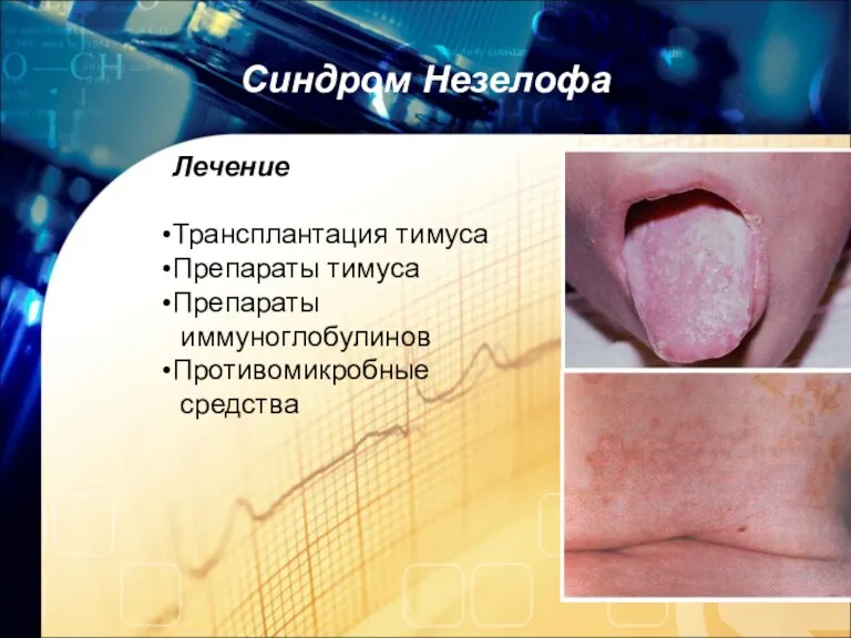Синдром Незелофа Лечение Трансплантация тимуса Препараты тимуса Препараты иммуноглобулинов Противомикробные средства